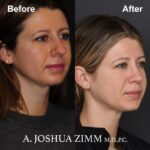 3 Rhinoplasty Before And After 36