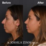 3 Rhinoplasty Before And After 38