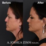 3 Rhinoplasty Before And After 4