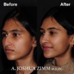 3 Rhinoplasty Before And After 40