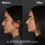 3 Rhinoplasty Before And After 43