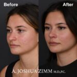 3 Rhinoplasty Before And After 44