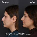 3 Rhinoplasty Before And After 45