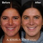 3 Rhinoplasty Before And After 46