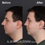 3 Rhinoplasty Before And After 47