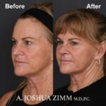 3 Rhinoplasty Before And After 48