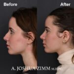 3 Rhinoplasty Before And After 49