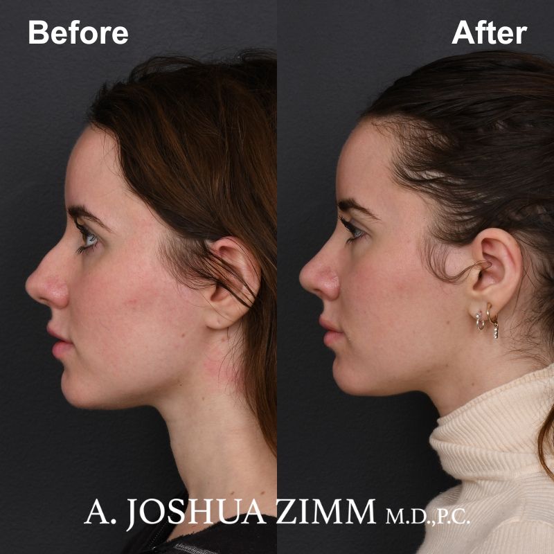 3 Rhinoplasty Before And After 49