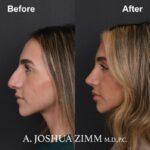 3 Rhinoplasty Before And After 5