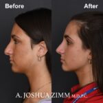 3 Rhinoplasty Before And After 51