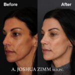 3 Rhinoplasty Before And After 52