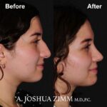 3 Rhinoplasty Before And After 54