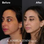 3 Rhinoplasty Before And After 56