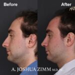 3 Rhinoplasty Before And After 57