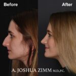 3 Rhinoplasty Before And After 58