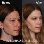 3 Rhinoplasty Before And After 59