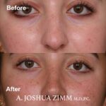 3 Rhinoplasty Before And After 61