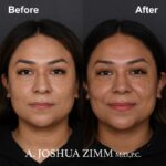 3 Rhinoplasty Before And After 7
