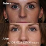 3 Rhinoplasty Before And After 8