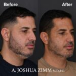 3.FaceTite AccuTite Before And After