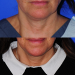 3mo Post Facetite FP
