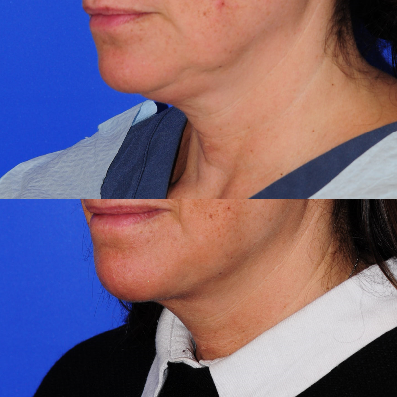3mo Post Facetite L3.4V 1