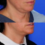 3mo Post Facetite R3.4V 1