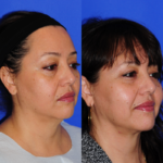 3mo Post Facetite R3.4V