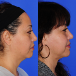 3mo Post Facetite RPNS