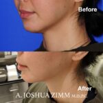 4 FaceTite AccuTite Before And Afte