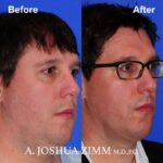 4 FaceTite AccuTite Before And After 1