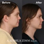 4 FaceTite AccuTite Before And After