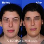 4 FaceTite AccuTite Before And After 2