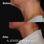 4 FaceTite AccuTite Before And After 3