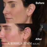 4 Otoplasty Before And After
