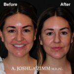 4 Chin Implant Before And After