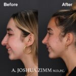 4 Chin Implant Before And After 2 1