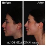4 Chin Implant Before And After 2