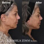 4 Facelift Before And After 1 1