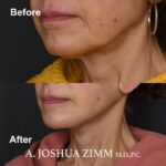 4 Facelift Before And After 2