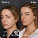 4 Revision Rhinoplasty 1