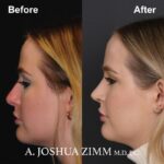 4 Revision Rhinoplasty