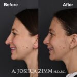4 Revision Rhinoplasty 3