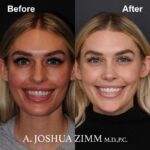 4 Rhinoplasty Before And After 1 1