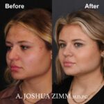 4 Rhinoplasty Before And After 1