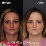 4 Rhinoplasty Before And After 10