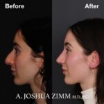 4 Rhinoplasty Before And After 15