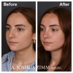 4 Rhinoplasty Before And After 16