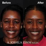 4 Rhinoplasty Before And After 17