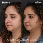 4 Rhinoplasty Before And After 18